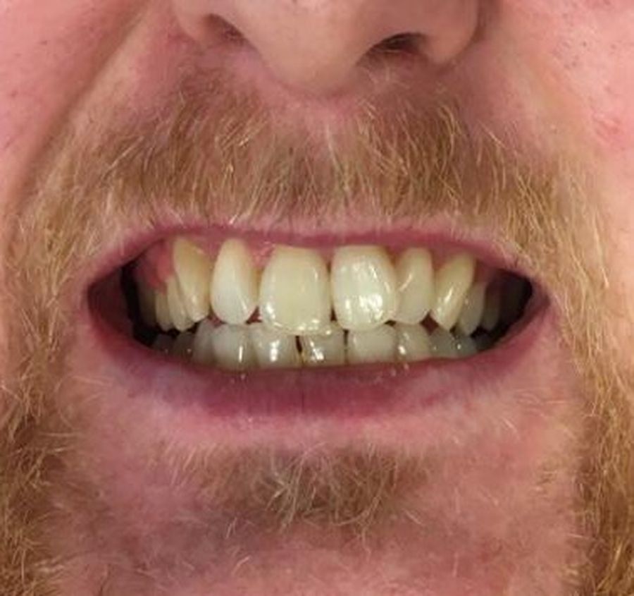 How 6 Month Braces Work - Karl - 6 month braces - before - 3Dental